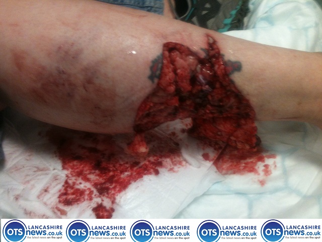 ots-dog attack victim bite blackpool southport ots onthespot otsnews.co.uk news_0